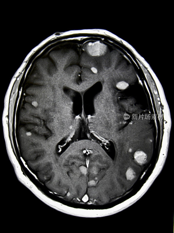 脑肿瘤- MRI